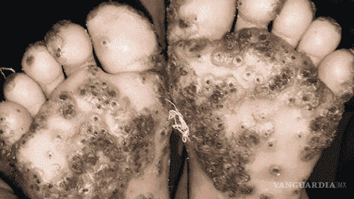 Pies de niña se infectan de pulgas luego de caminar descalza en zona rural de Brasil