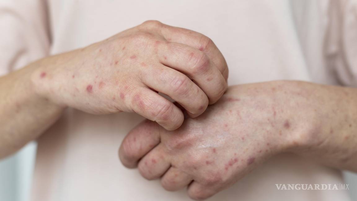 $!Identificar a tiempo los principales síntomas del sarampión permite actuar de manera oportuna