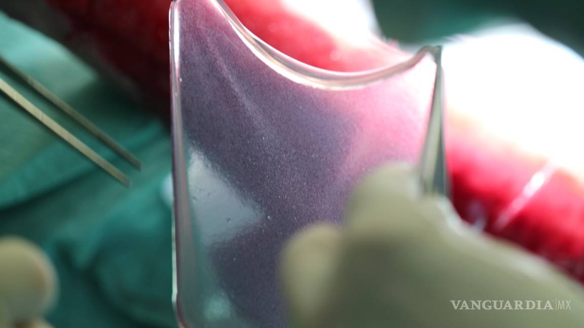 $!Trasplantan casi por completo piel de un niño enfermo