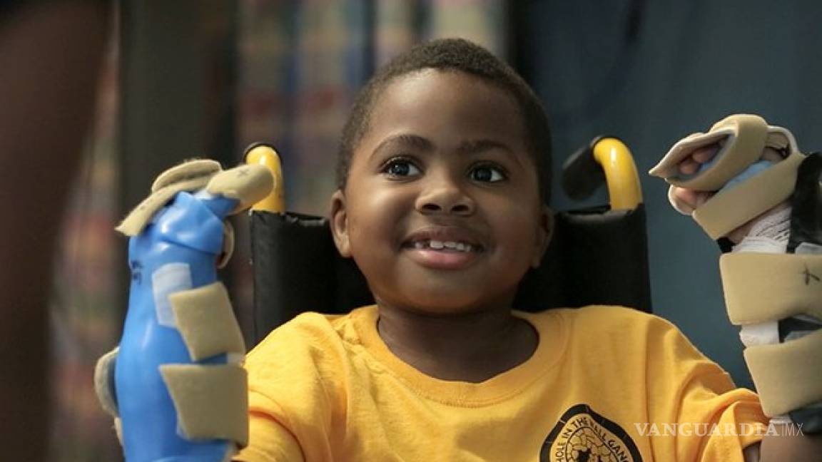 Logran primer trasplante de manos a niño sin parentesco con donante