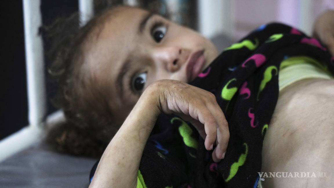 $!Mayar Al-Arja, un niño de 2 años que sufre de desnutrición, en el Hopsital Nasser de Jan Yunis en la Franja de Gaza.