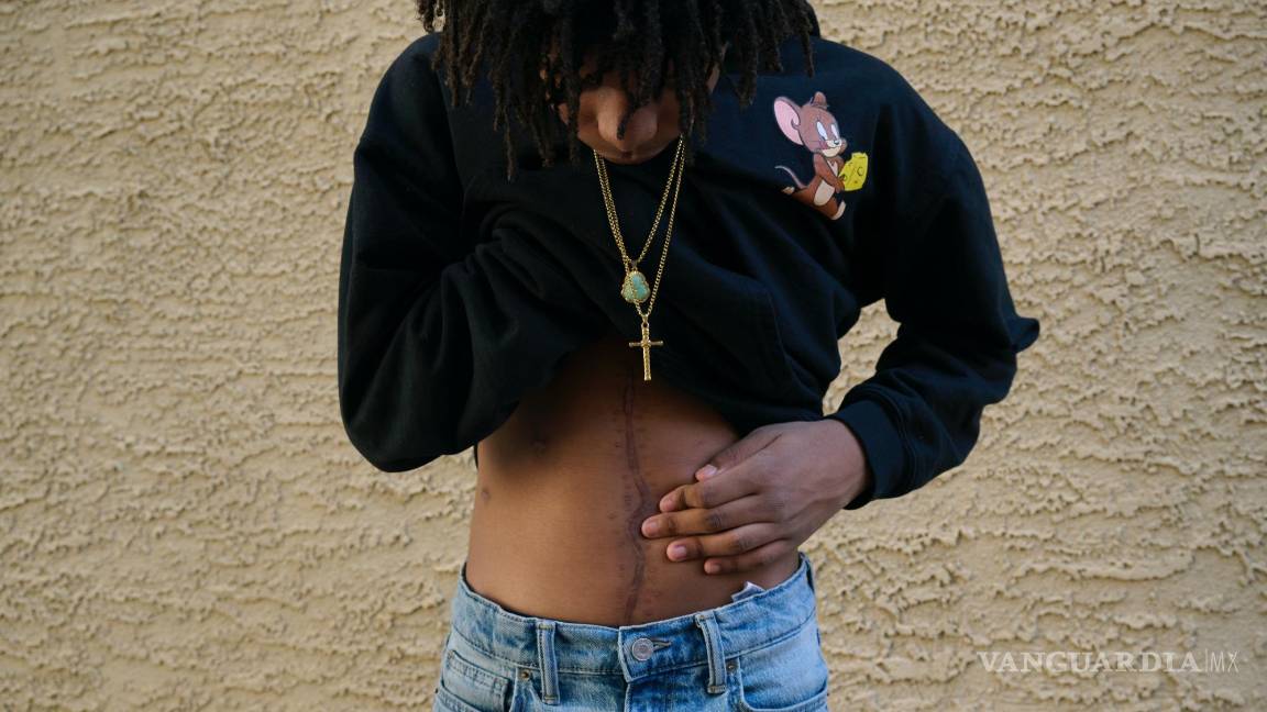 $!Caison Robinson, de 14 años, quien sufrió heridas de cinco disparos que fueron disparados en cuestión de momentos, muestra una cicatriz de su cirugía.