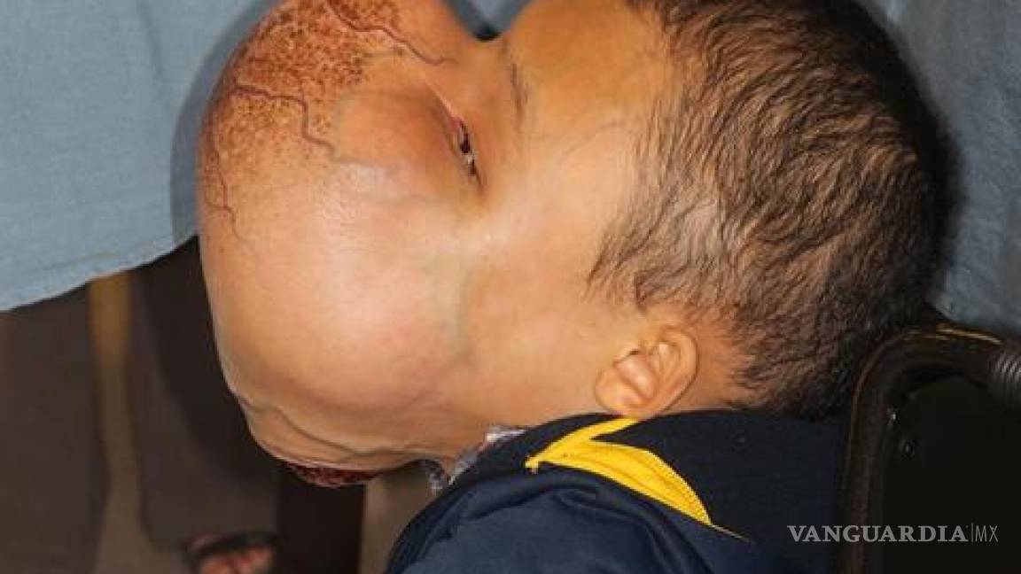 Muere niño al que le extirparon tumor de 4.5 kilos del rostro, días después de la operación