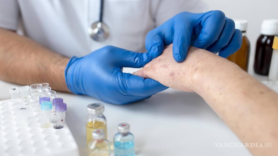 $!Al cabo de uno o dos días por lo general aparece una erupción cutánea que suele empezar en forma de manchas rojas planas.