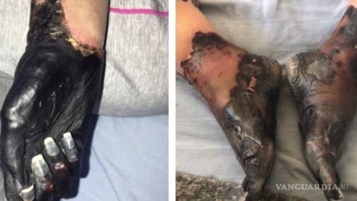 $!Le diagnosticaron asma, pero terminaron amputándole piernas y mano