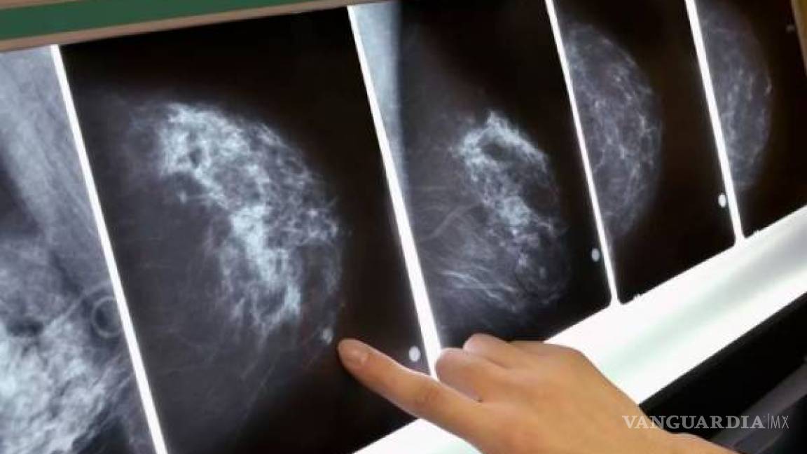 Google crea inteligencia artificial que detecta cáncer de mama mejor que los médicos