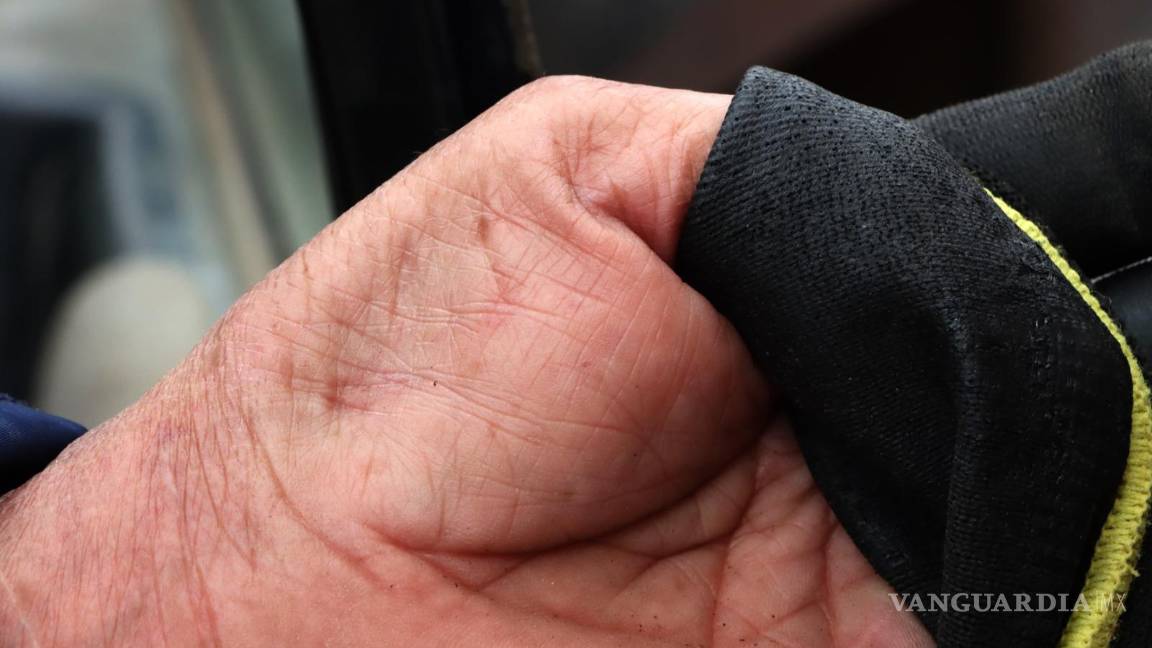 $!La lesión afectó la movilidad de una de sus manos de don José Cruz Chávez Castillo.