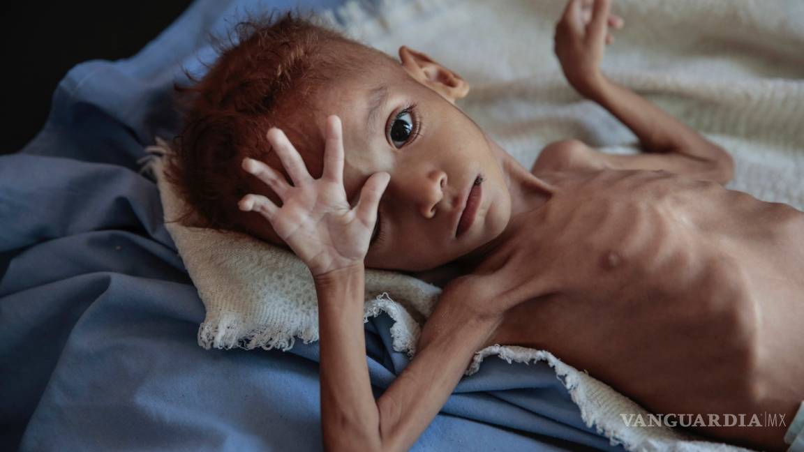 $!Según Save the Children, el hambre habría matado a 85 mil niños en Yemen