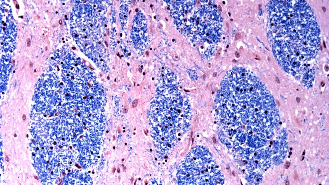 Sorprendente hallazgo revela cuál es la causa de enfermedad de Huntington, un trastorno cerebral fatal