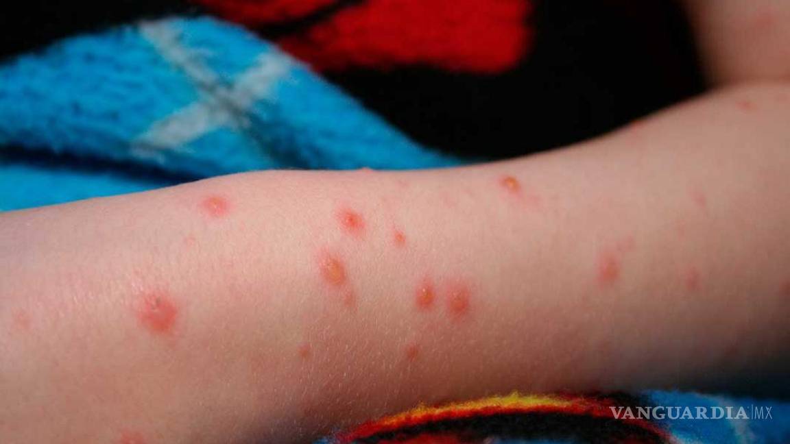 Incrementan 140 por ciento casos de varicela en Coahuila