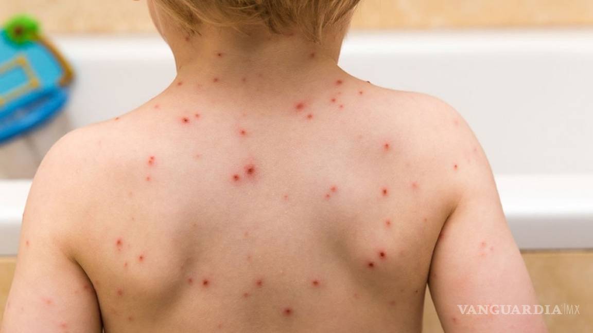 En Coahuila alertan por brote de varicela; 552 casos en 2 meses de 2019