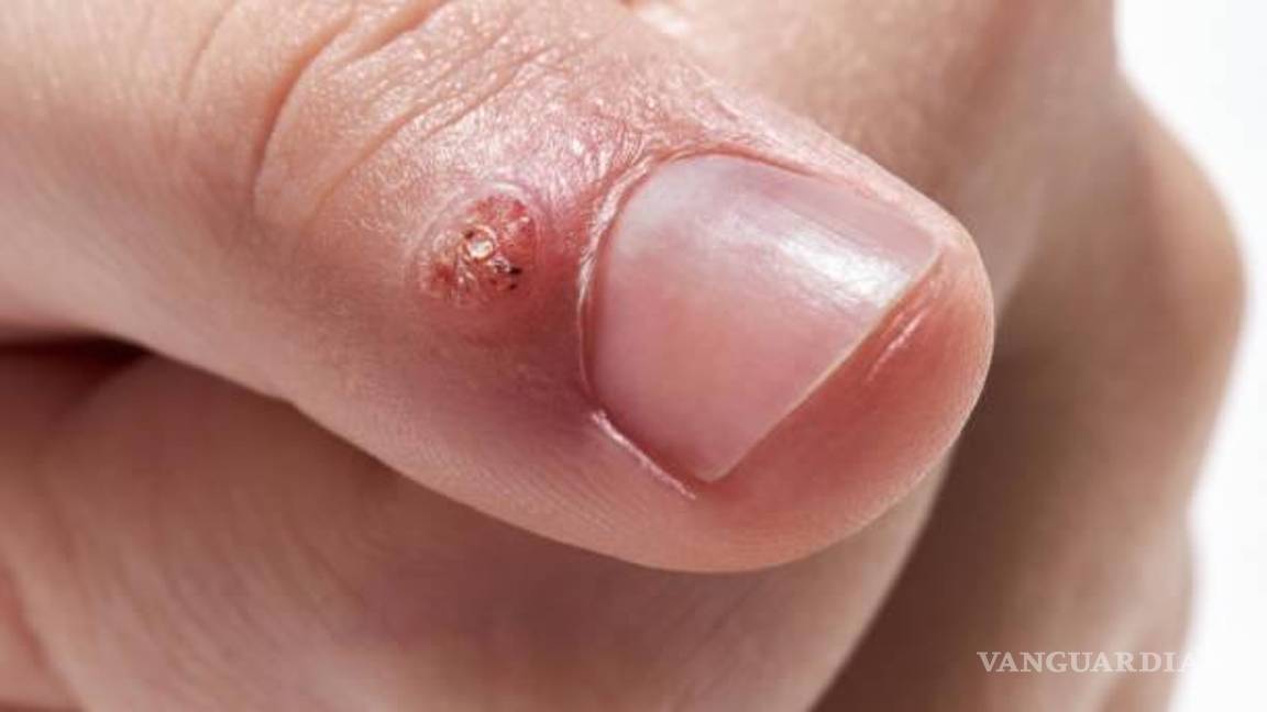 $!Estas molestas lesiones pueden surgir en diversas partes del cuerpo, como dedos, manos, brazos, cuello y cara.