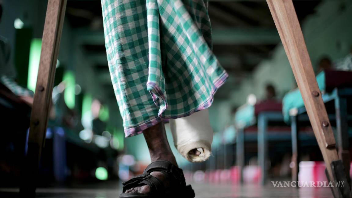 $!Imagen de un enfermo de lepra, enfermedad muy relacionada con la pobreza.