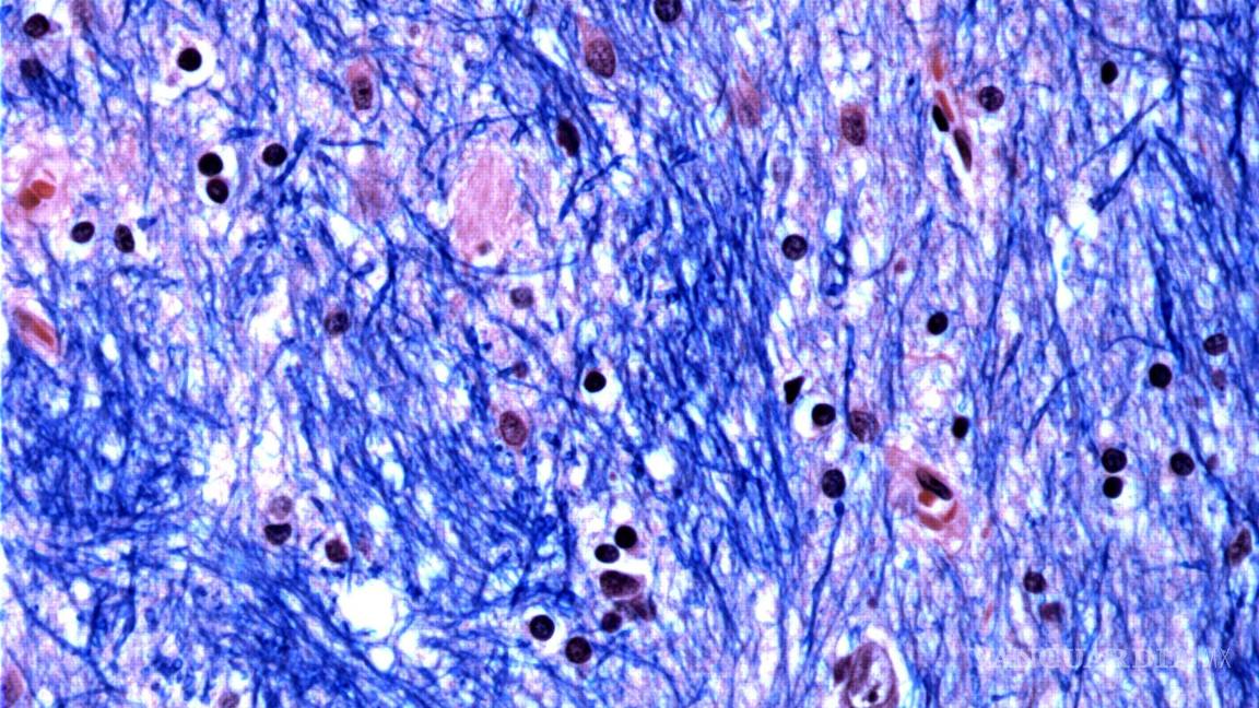 $!Los científicos están desentrañando el misterio de qué es lo que desencadena la enfermedad de Huntington, un trastorno hereditario devastador y mortal.