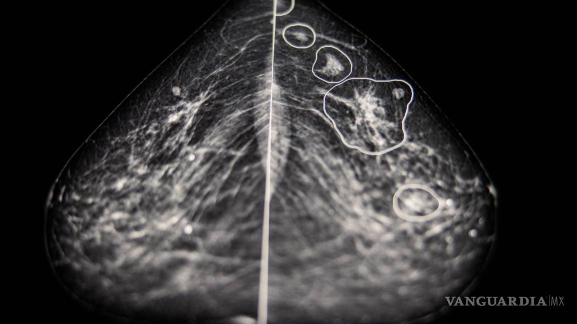 Usan inteligencia artificial para detectar el cáncer de mama que los médicos no ven