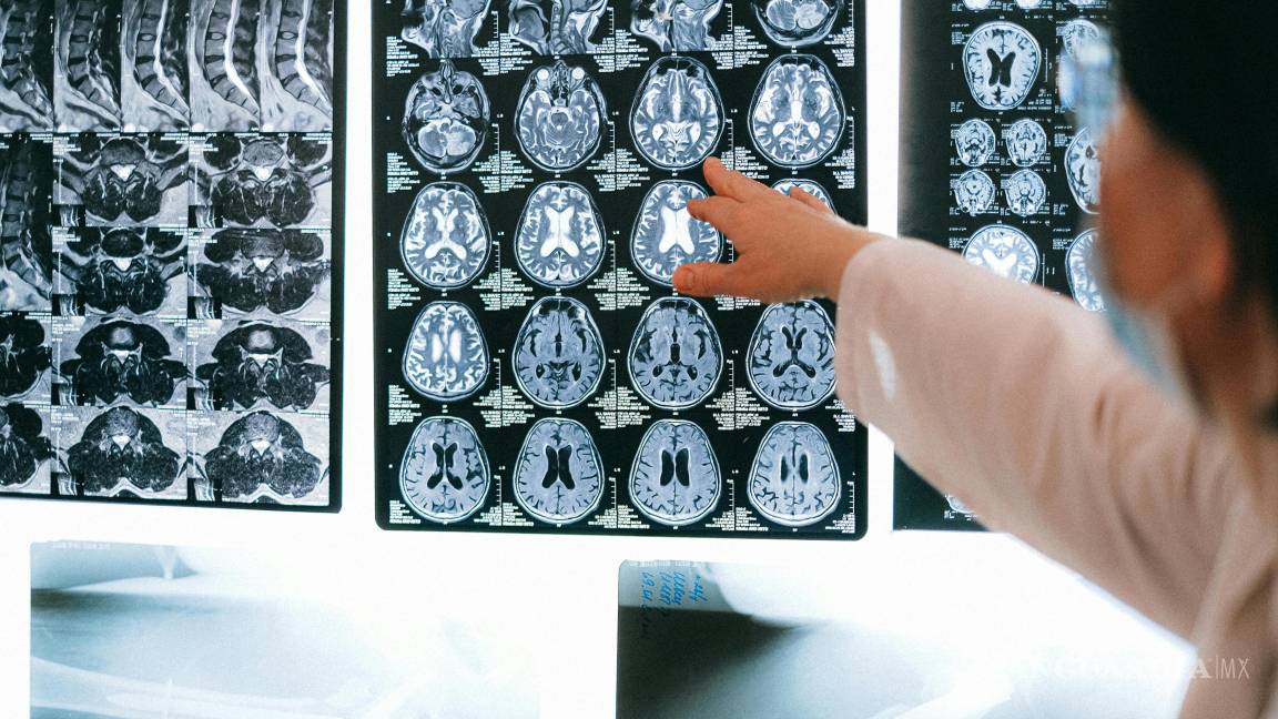 $!Los fármacos que estimulan las células inmunitarias del cerebro para eliminar la beta amiloide son cada vez más eficaces, pero aún no curan el Alzheimer.