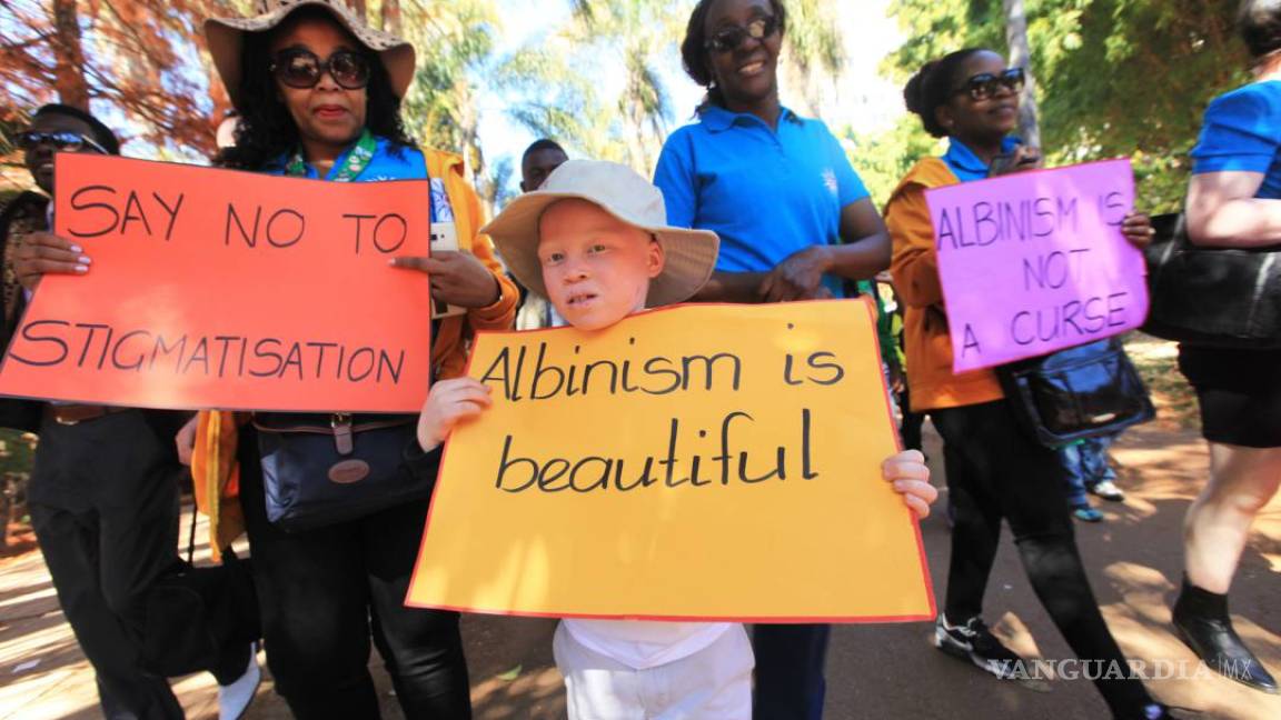 Sufren los Albinos en Zimbabue de exclusión social