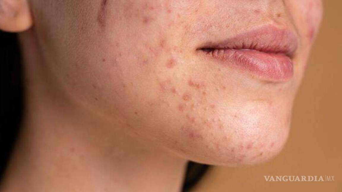 $!Los productos de aplicación tópica con un dos por ciento de ácido salicílico ayudan a tratar el acné corporal.