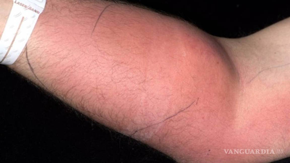 $!Se inyectó semen para curarse un dolor y esto fue lo que pasó...