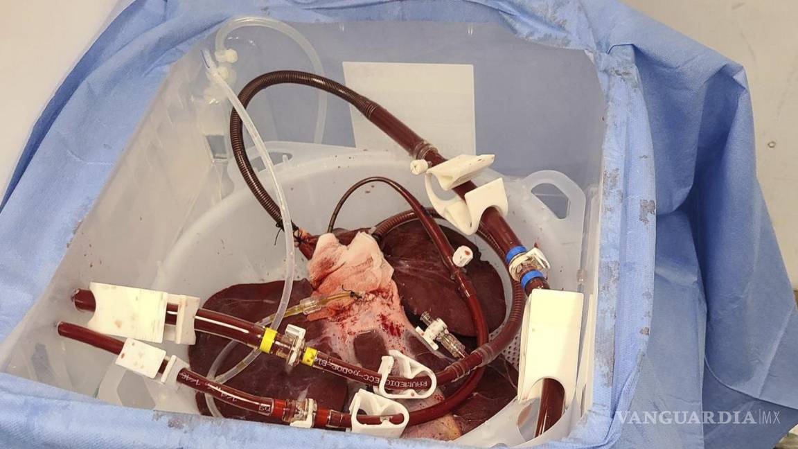 $!Cirujanos conectaron externamente el hígado de cerdo a un cuerpo humano con muerte cerebral y observaron cómo filtraba la sangre con éxito.
