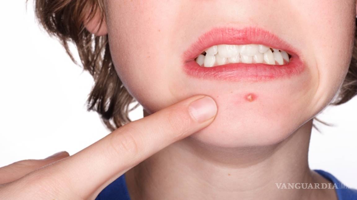 ¿Es bueno tomar antibióticos para evitar el acné?