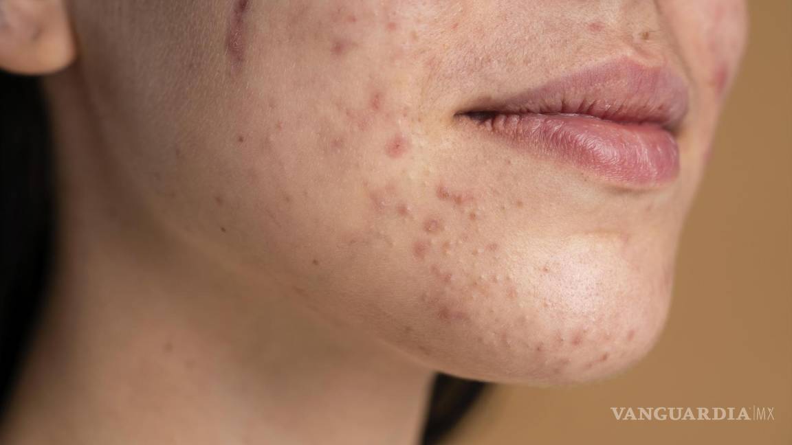 $!El acné relacionado con el estrés a menudo se resuelve por su cuenta cuando el estresante disminuye.