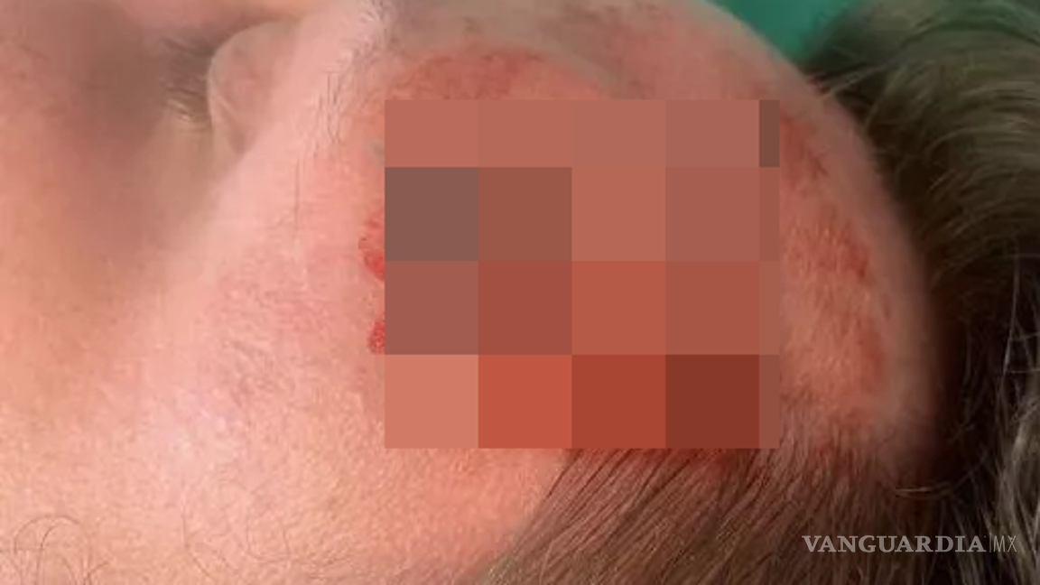 Le dolía mucho la cabeza, creía que era migraña; le extrajeron un gusano de 15 centímetros