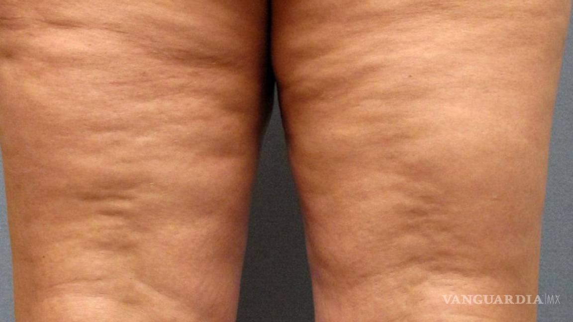 $!¿Vinagre de manzana para eliminar celulitis? Aquí te decimos cómo lograrlo