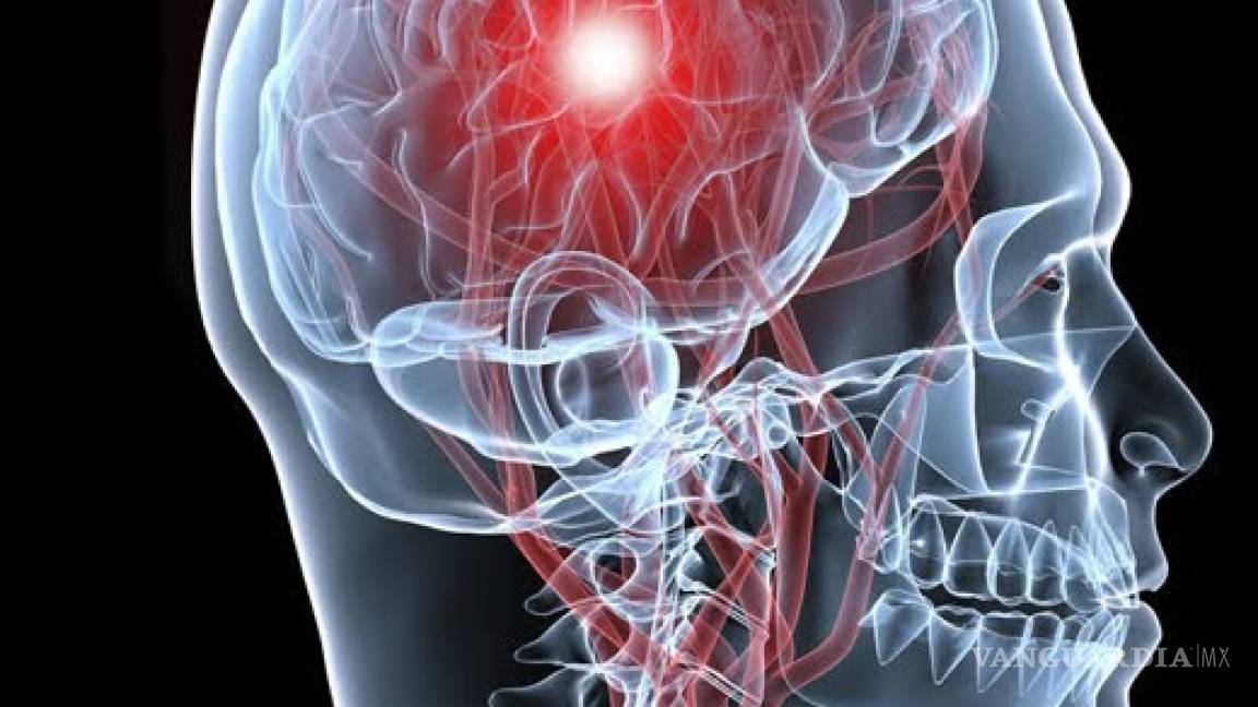 Derrame cerebral ¿Cómo prevenirlo?