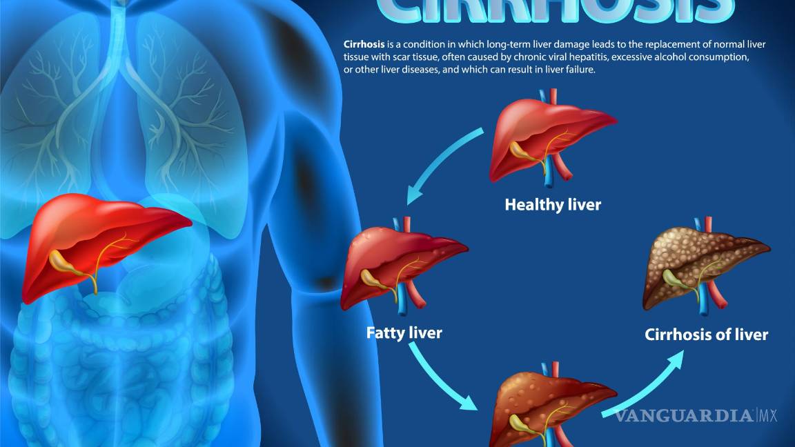 $!La primera fase de la enfermedad es la hepatopatía grasa, o esteatosis.