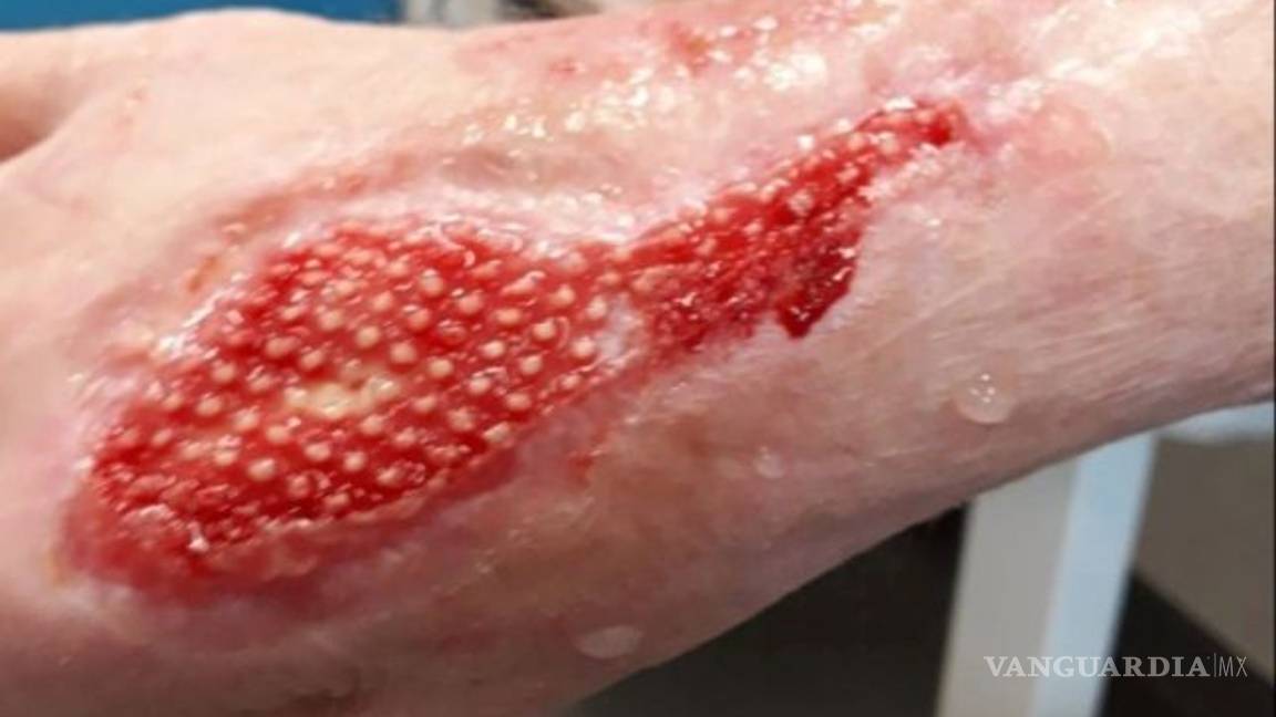 $!Una mujer estuvo entre la vida y la muerte por un arañazo de su gato