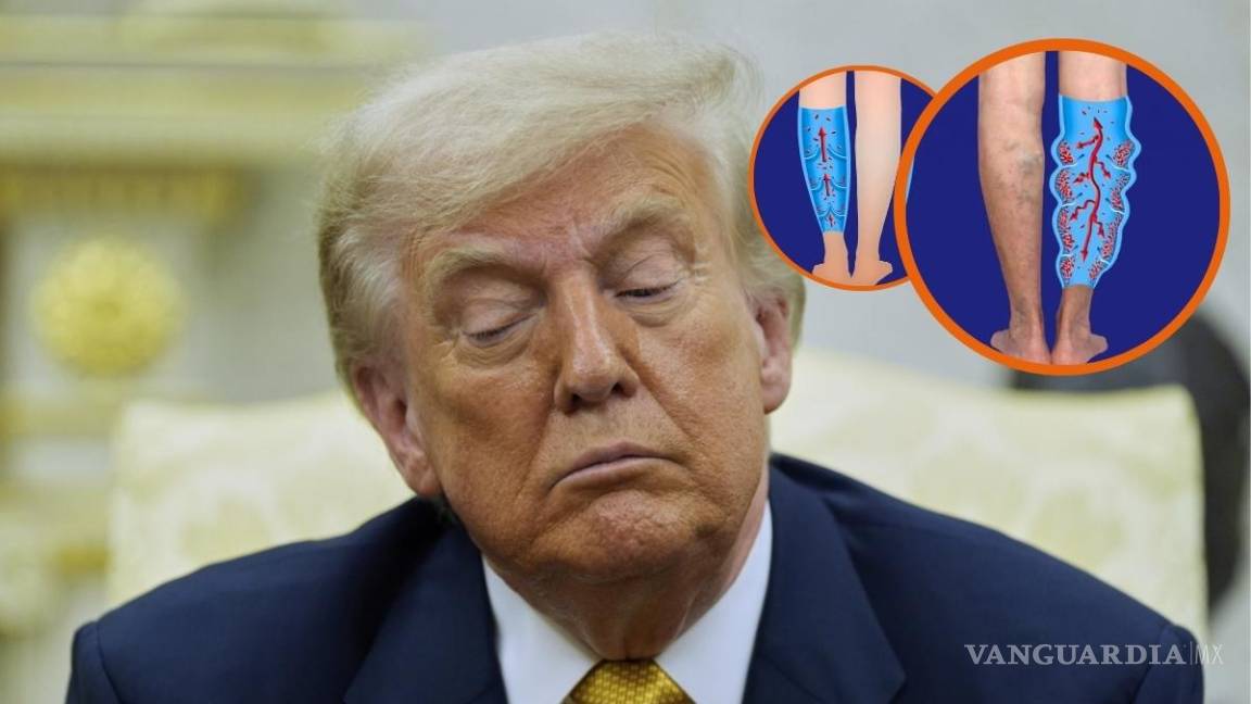 ¿Qué es la insuficiencia venosa crónica? Enfermedad por la que hospitalizaron a Donald Trump