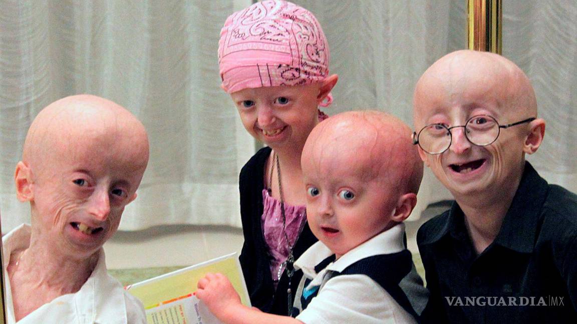 $!FotografÍa facilitada por Juan Carlos IzpisÍa, director del Centro de Investigación de Medicina Regenerativa de Barcelona (CMRB), de varios pacientes con progeria.