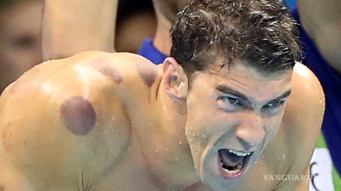 $!Te explicamos la razón de las extrañas marcas que tiene Michael Phelps en su cuerpo