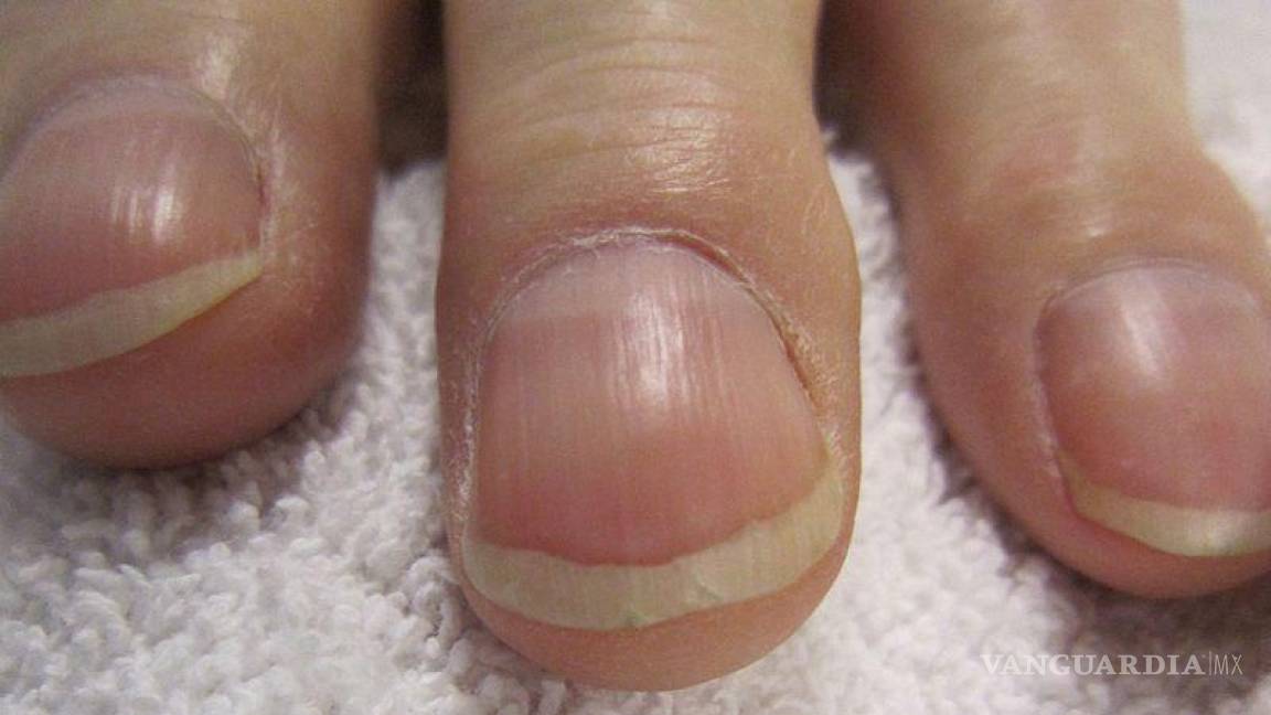 ‘Clubbing’: tus uñas dan señales de que podrías padecer cáncer. Aquí te contamos cómo identificarlas