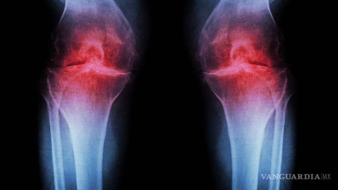 $!Cada vez más jóvenes padecen osteoartritis, por obesidad