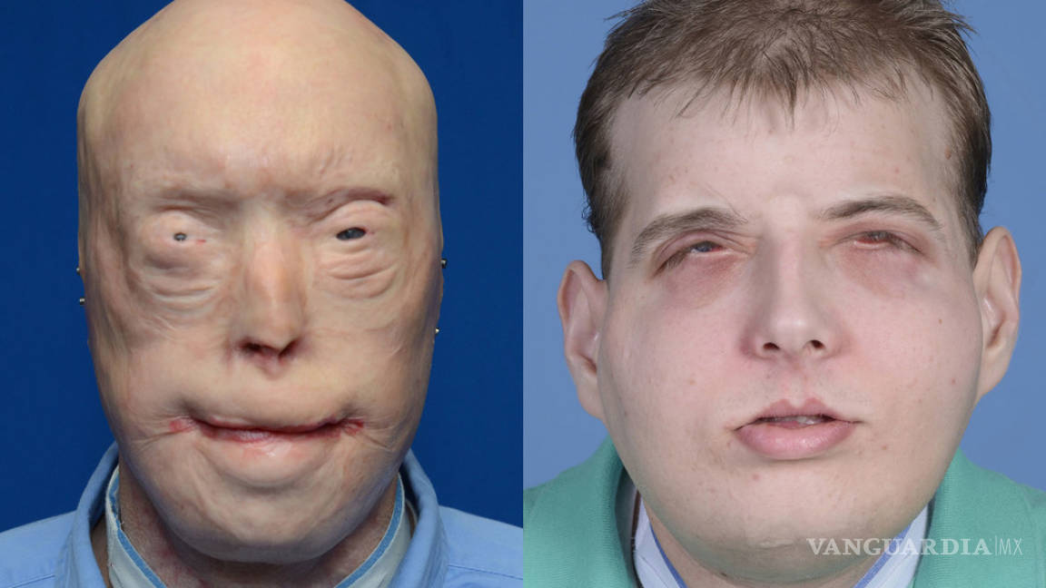 Realizan con éxito el trasplante de cara más completo del mundo