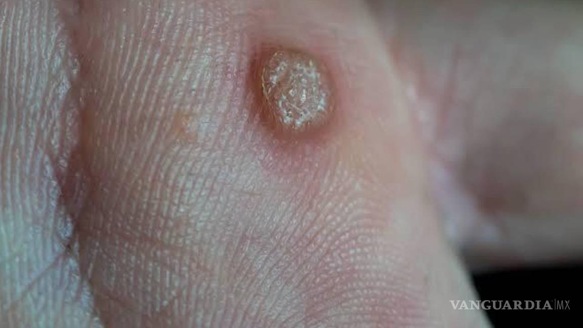 $!Es importante tener precaución con los remedios caseros, ya que pueden complicar el tratamiento y no eliminar el virus por completo.