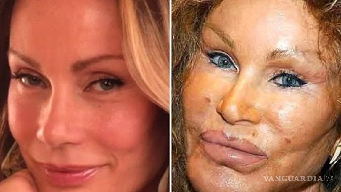 $!¿Una cirugía más? Axl Rose y Mickey Rourke lucen irreconocibles