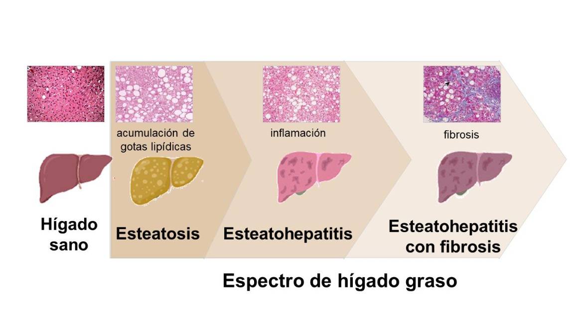 $!Gráfica cedida por el equipo de investigadores del CIMUS sobre cómo se llega a desarrollar la fibrosis hepática.