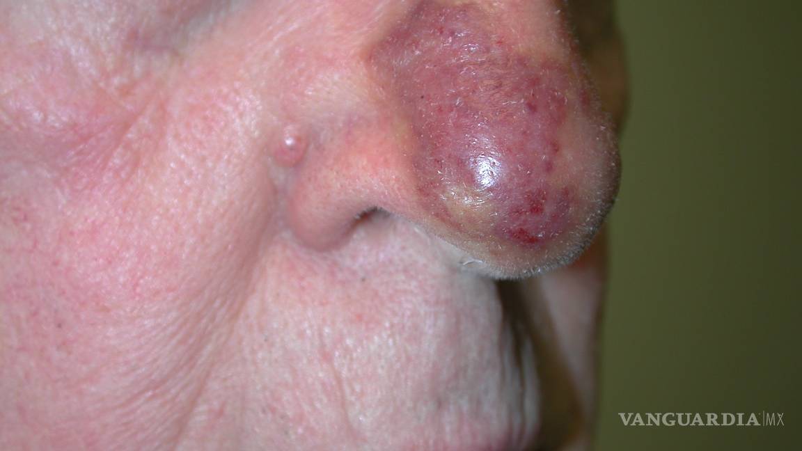 $!Estudio con pacientes de angiosarcoma revela posibles nuevas terapias