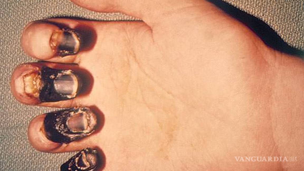 $!Peste negra, cómo se contagia, cuáles son los síntomas y su tratamiento