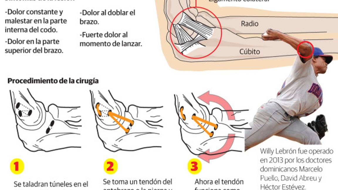 La primera cirugía Tommy John