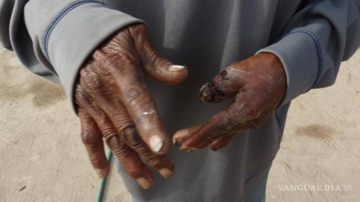 $!Habitantes de La Laguna ya muestran muerte de tejidos por el consumo prolongado de arsénico. Crédito: Jesús Peña/Vanguardia