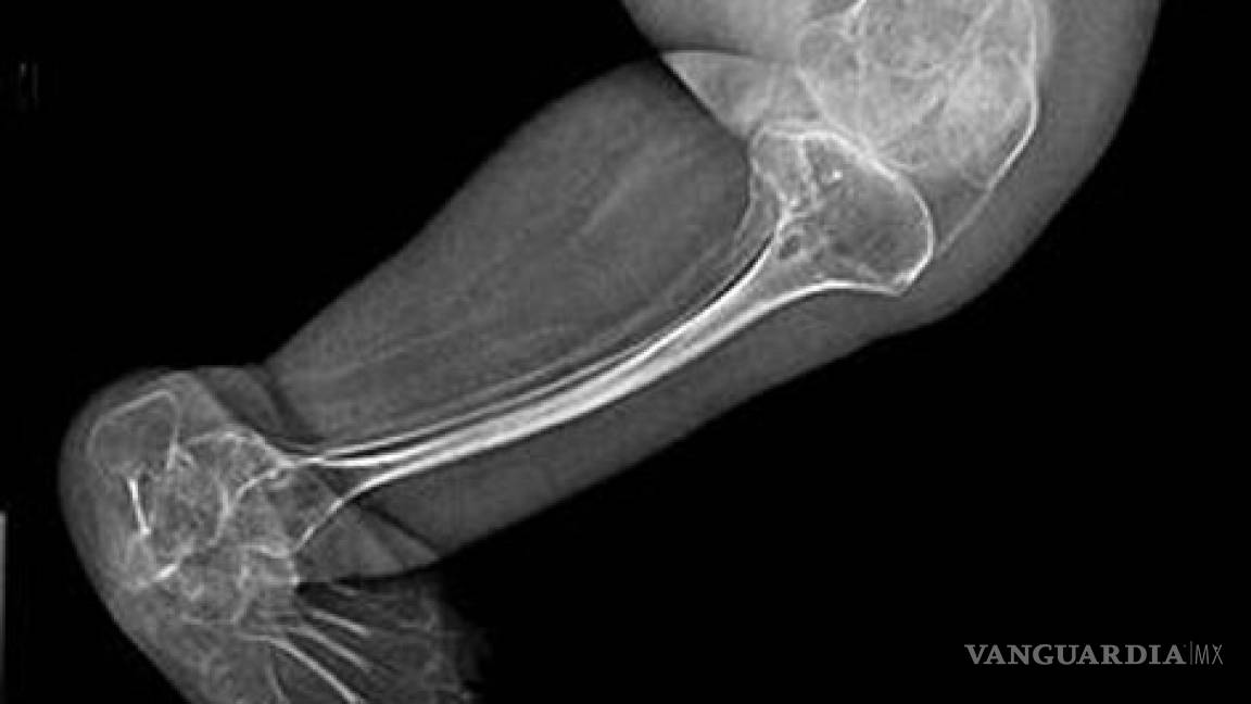 Identifican gen que causa &lt;EM&gt;huesos de cristal&lt;/EM&gt;