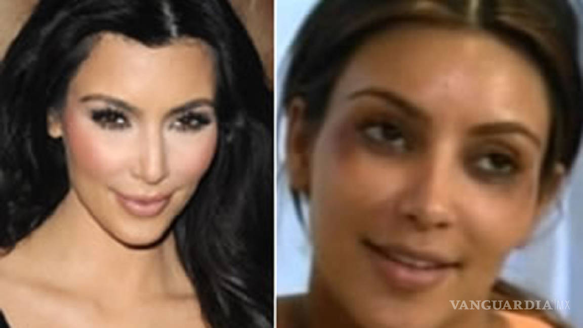 Kim Kardashian Sufre Accidente Con El B Tox