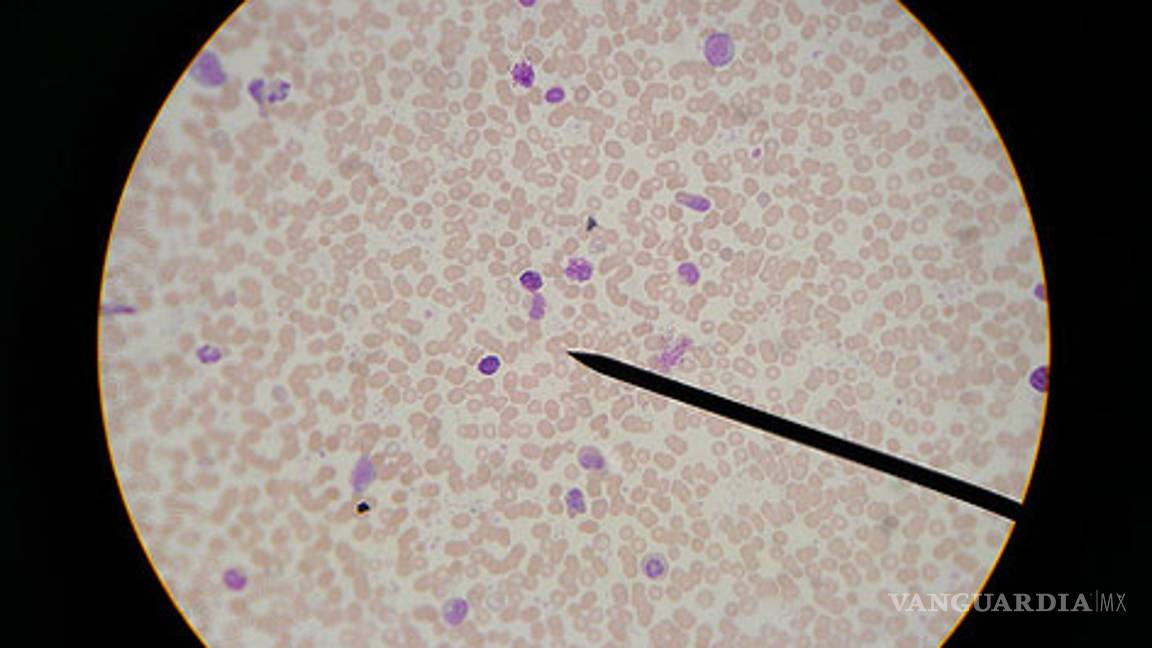 Diagnostican leucemia aguda en tiempo real