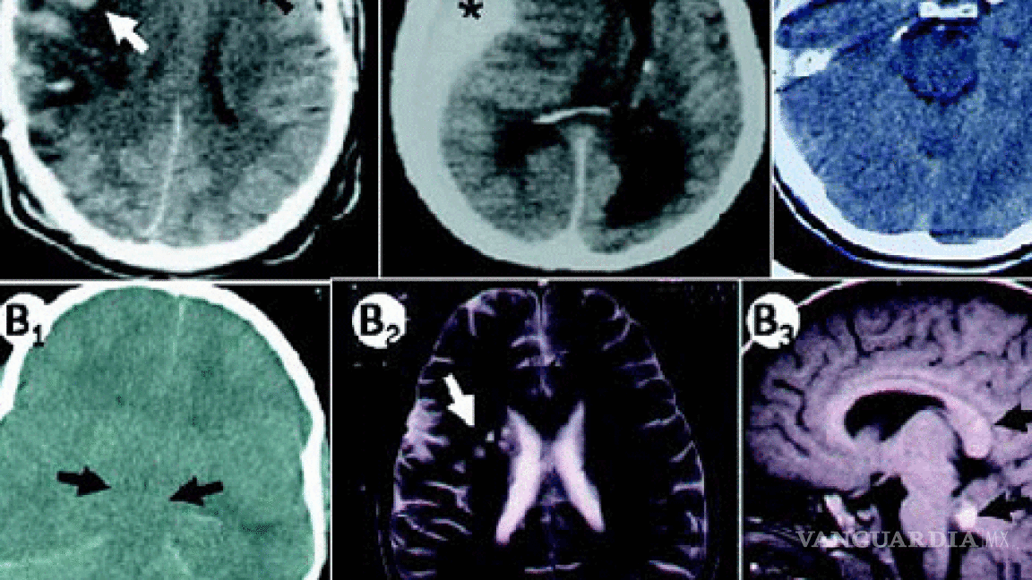 Neuroimagen de última generación permite tratar a pacientes en coma