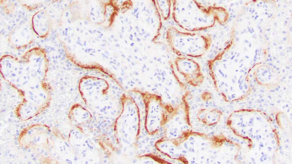 $!Células placentarias de un mortinato con COVID-19. AP/College of American Pathologists/Archives of Pathology and Laboratory Medicine