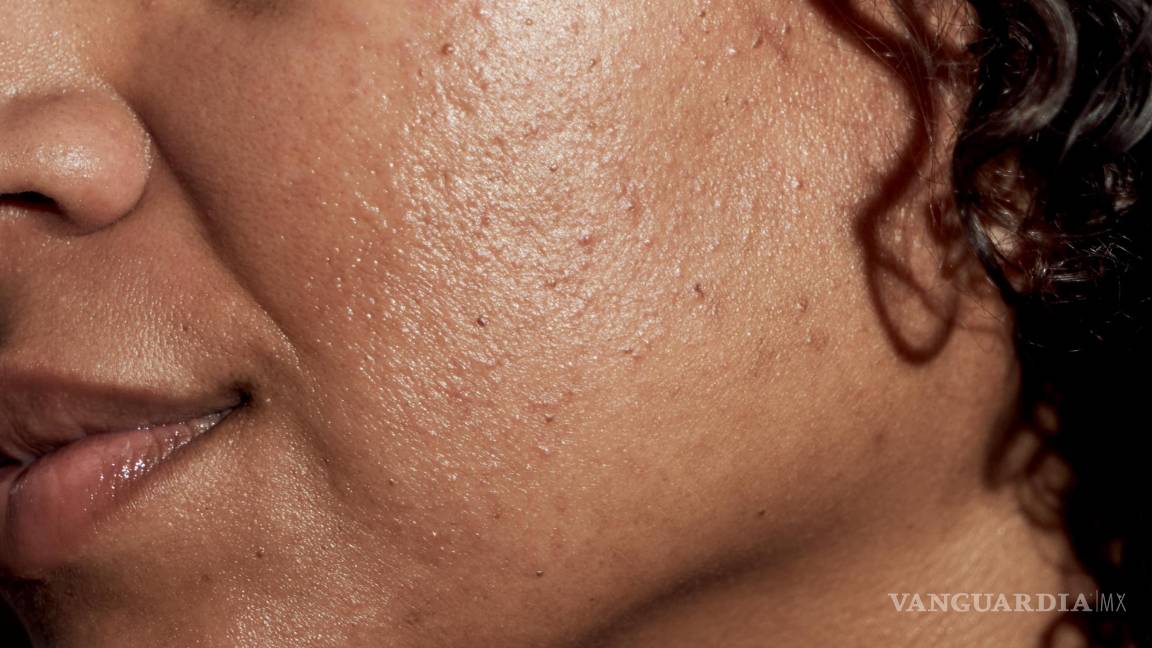 $!Si notas cicatrices o manchas oscuras en tus brotes o si tu acné está acabando con tu autoestima, vayas a ver a un dermatólogo.